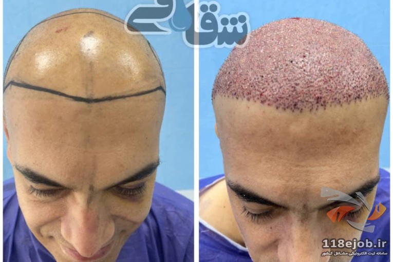بهترین کلینیک کاشت مو در مشهد