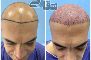 بهترین کلینیک کاشت مو در مشهد
