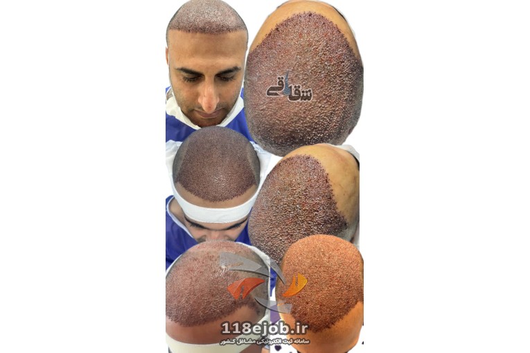 بهترین کلینیک کاشت مو ( شقاقی ) در مشهد