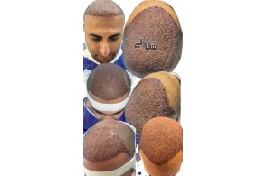 بهترین کلینیک کاشت مو ( شقاقی ) در مشهد