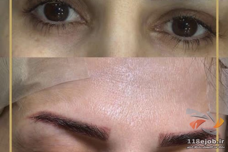 کلینیک کاشت مو و ابرو بهار در گرگان