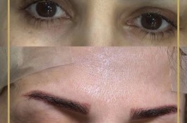 کلینیک کاشت مو و ابرو بهار در گرگان