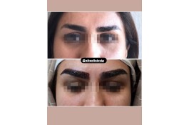 کلینیک کاشت مو و ابرو نیتا در رشت