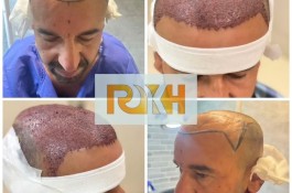 کلینیک کاشت مو و زیبایی رخ در شیراز