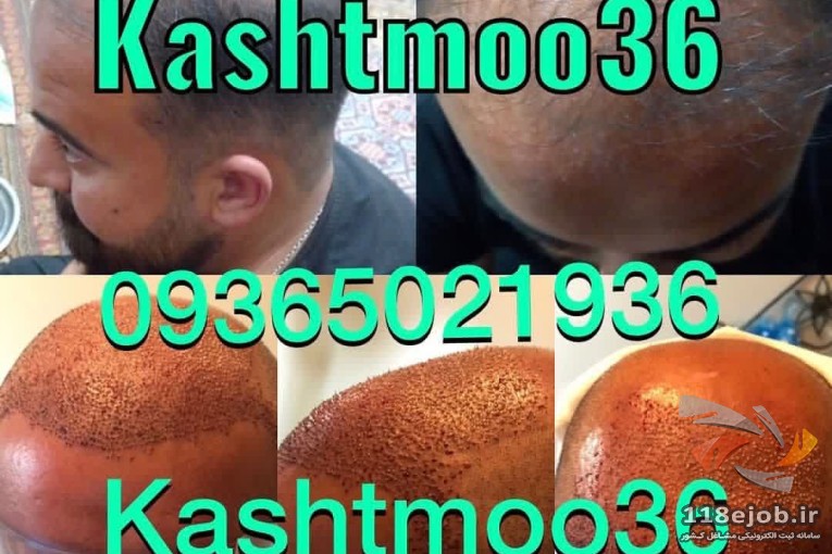 بهترین کلینیک کاشت مو و ابرو در شیراز - کلینیک کاشت مو و ابرو سمیه فلاح در شیراز
