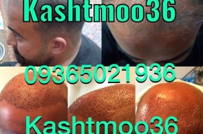 بهترین کلینیک کاشت مو و ابرو در شیراز - کلینیک کاشت مو و ابرو سمیه فلاح در شیراز